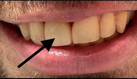 Implantes Dentales