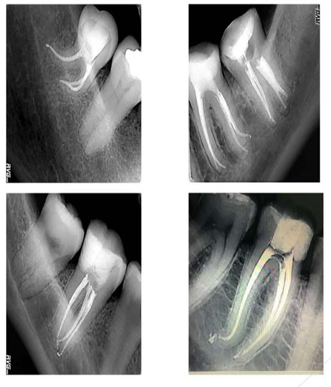 Endodoncia